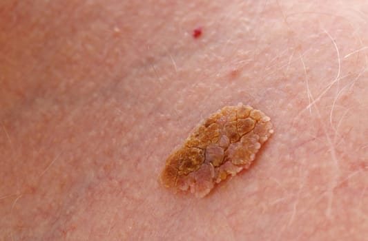 Benign melanoma - malignant tumor of the skin.