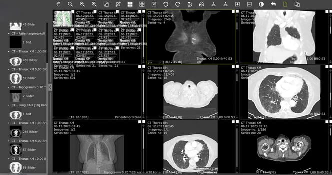 Frankfurt, Germany - January 28, 2024: computed Tomography of a lung with illness fibrosis