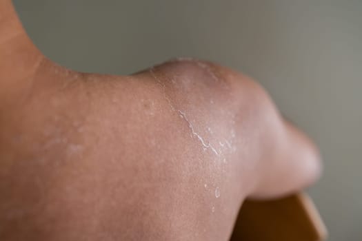 Man get sun burn with sloughs off on his shoulder