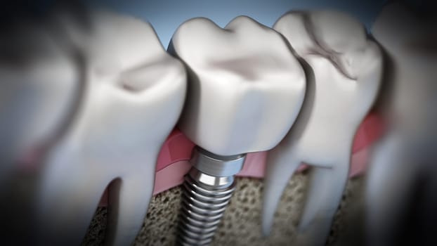 3D rendering of tooth implant showing jaw gum and bone layers. 3D illustration.