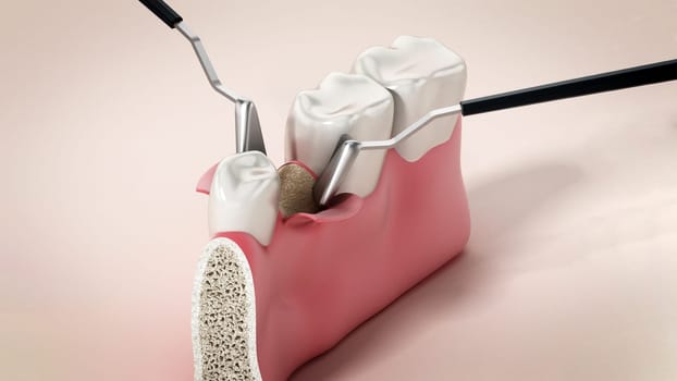 3D illustration of mid-crestal incision dental operation. 3D illustration.