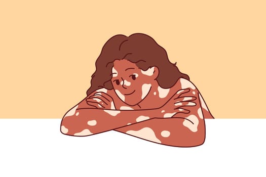 African American woman with vitiligo syndrome and spots on skin smiles, leaning elbows on white surface. Beautiful vitiligo girl calls for attention to dermatological problems caused by pigmentation