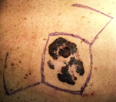 Melanoma malignant skin cancer