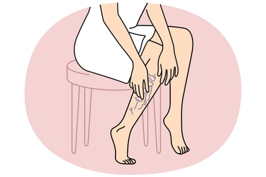 Woman touching legs with varicose veins. Female with vascular leg disease suffer from enlarged blood vessels. Vector illustration.