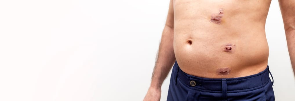 Banner Laparoscopic Appendectomy Surgery. Three Scars in Abdomen Area. Horizontal Copy Space. Surgical Marks from Abdominal Procedure, Medical Operation. Trauma and Emergency Appendicitis High quality