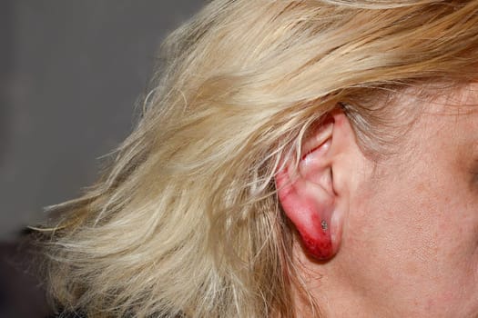 Inflamed and bloody earlobe after ear piercing