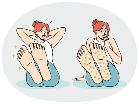 Woman with rash on feet suffers from allergies and fungal infection that causes severe itching and odor. Sad and happy girl before and after applying healing cream to fight fungus on feet