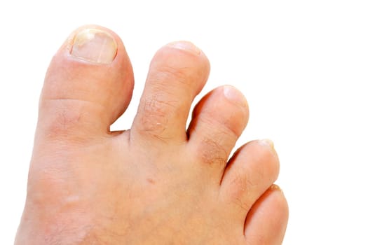 A dermatological disease affecting the toenails caused by a fungus. Selective focus with shallow depth of field.