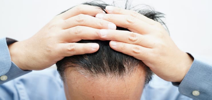 Bald head in man, hair loss treatment health problem.