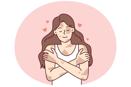 Positive girl with vitiligo disease hugging herself taking skin diseases as personal feature. Concepts of body positivity in people suffering from dermatological illness or vitiligo syndrome