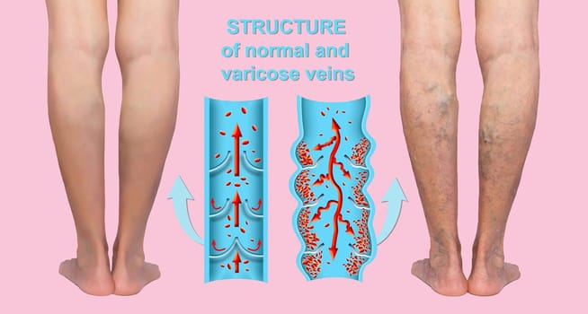 Varicose veins on a female senior legs. The structure of normal and varicose veins. Concept of dry skin, old senior people, varicose veins and deep vein thrombosis or DVT