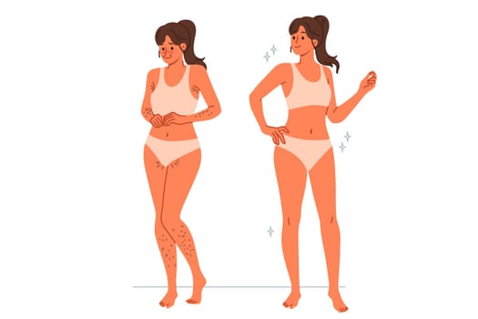 Girl uses depilation and laser hair removal, demonstrating result of visit to cosmetologist. Young woman recommends depilation of legs and face or bikini area using sugaring or hot wax