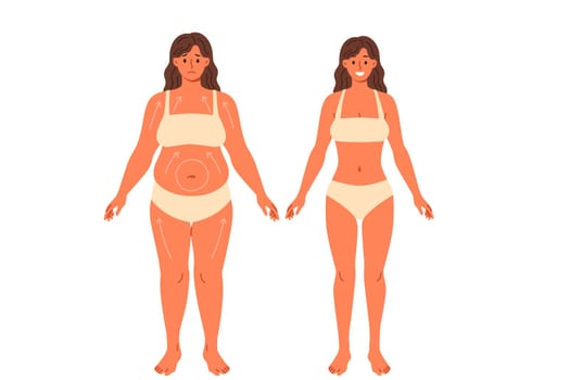 Liposuction for overweight woman posing in underwear before and after surgery. Beautiful girl in need of liposuction demonstrates progress achieved without use of diets and fitness
