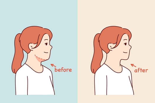 Double chin removal surgery for young girl posing before and after procedure with cosmetologist. Losing excess weight caused woman to get rid of double chin and increase attractiveness.