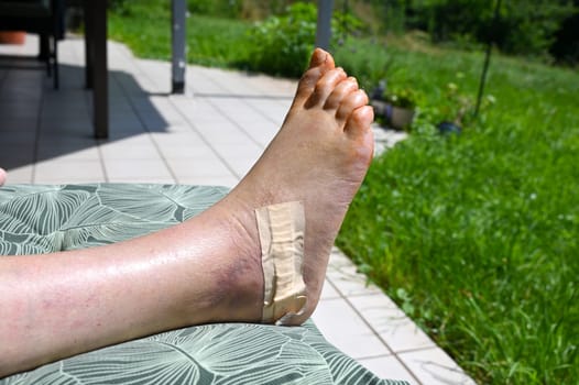 Foot raised on a terrace after an operation for a heel bone fracture, scar covered with a plaster
