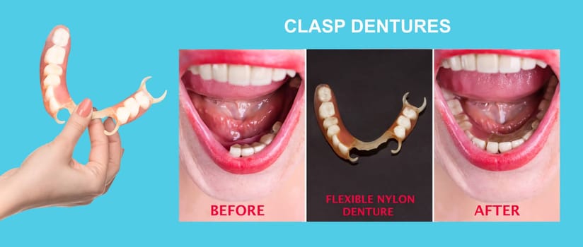 flexible nylon denture on female hand. Removable dentures flexible, devoid of nylon, hypoallergenic exempt from monomer