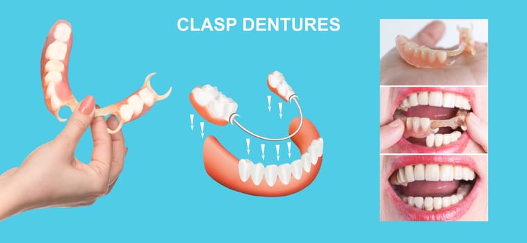 flexible nylon denture on female hand. Removable dentures flexible, devoid of nylon, hypoallergenic exempt from monomer