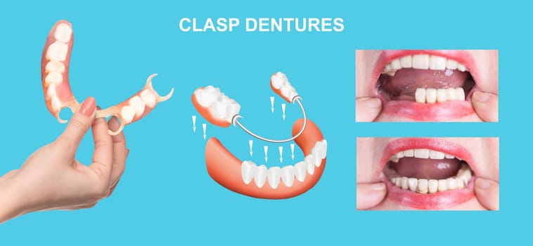 flexible nylon denture on female hand. Removable dentures flexible, devoid of nylon, hypoallergenic exempt from monomer
