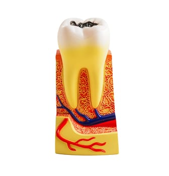 Decay tooth replace with dental implant root canal teeth model for education isolated on white background with clipping path.