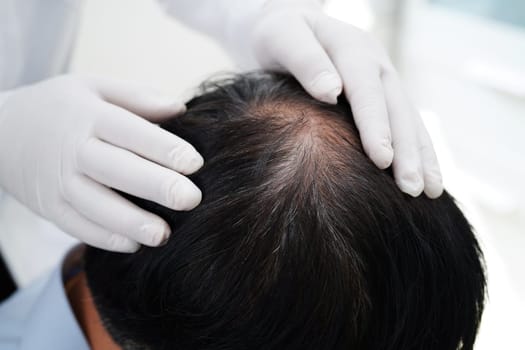Doctor touch bold head in man, hair loss treatment health problem.