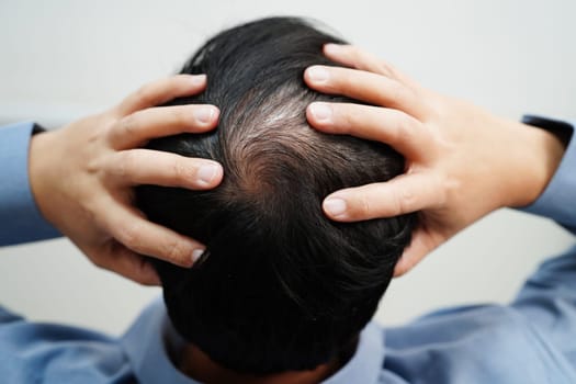 Bald head in man, hair loss treatment health problem.