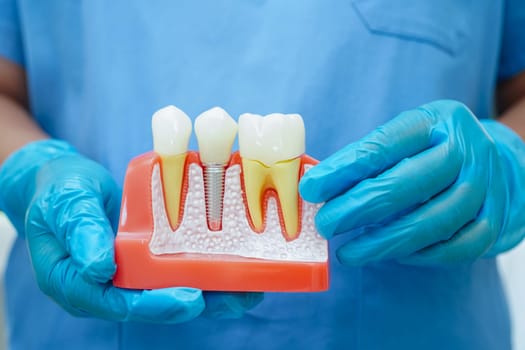 Dentist holding dental implant, artificial tooth roots into jaw, root canal of dental treatment, gum disease, teeth model for dentist.