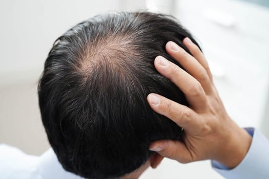 Bald head in man, hair loss treatment health problem.