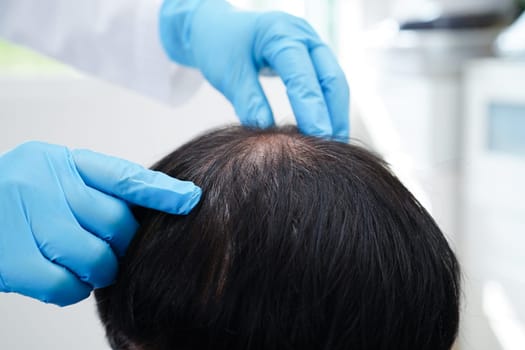 Doctor touch bold head in man, hair loss treatment health problem.