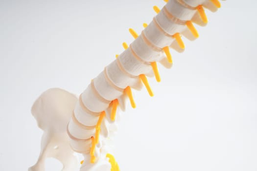 Spinal nerve and bone, Lumbar spine displaced herniated disc fragment, Model for treatment medical in the orthopedic department.