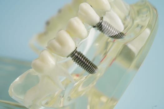 Dental implant, artificial tooth roots into jaw, root canal of dental treatment, gum disease, teeth model for dentist studying about dentistry.