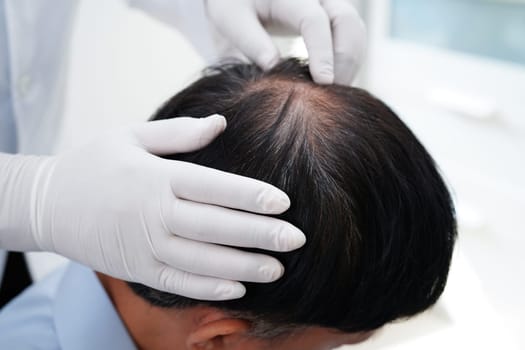 Doctor touch bold head in man, hair loss treatment health problem.