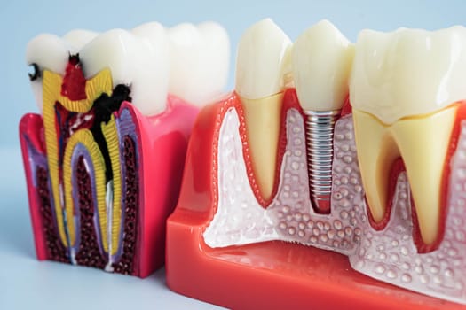 Dental implant, artificial tooth roots into jaw, root canal of dental treatment, gum disease, teeth model for dentist studying about dentistry.