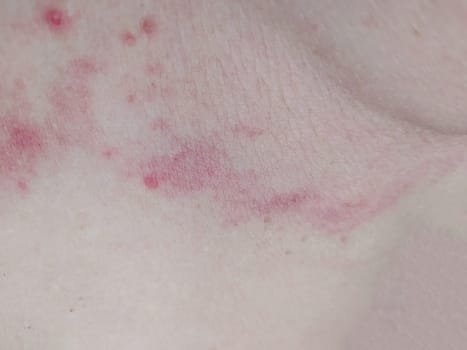 Fungus mycosis, fungal rash on woman's skin, closeup