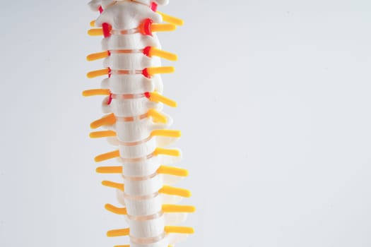 Spinal nerve and bone, Lumbar spine displaced herniated disc fragment, Model for treatment medical in the orthopedic department.