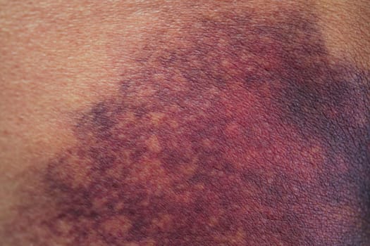 Asian woman dark bruise on the buttocks from a slip accident in the bathroom.