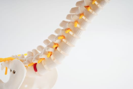 Spinal nerve and bone, Lumbar spine displaced herniated disc fragment, Model for treatment medical in the orthopedic department.