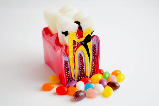 Tooth decay with sweet sugar candy, bad food for dental health care.