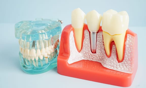 Dental implant, artificial tooth roots into jaw, root canal of dental treatment, gum disease, teeth model for dentist studying about dentistry.