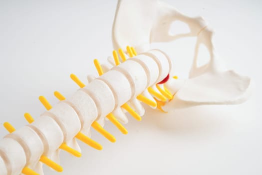 Spinal nerve and bone, Lumbar spine displaced herniated disc fragment, Model for treatment medical in the orthopedic department.
