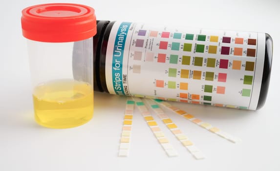 Urinalysis, urine cup with reagent strip pH paper test and comparison chart in laboratory.