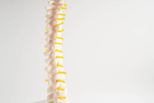 Spinal nerve and bone, Lumbar spine displaced herniated disc fragment, Model for treatment medical in the orthopedic department.