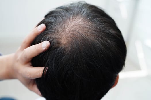 Bald head in man, hair loss treatment health problem.