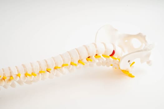 Spinal nerve and bone, Lumbar spine displaced herniated disc fragment, Model for treatment medical in the orthopedic department.