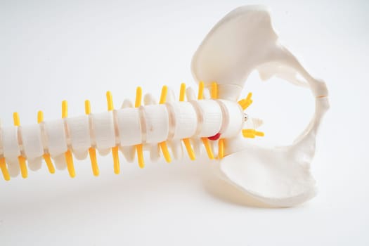 Spinal nerve and bone, Lumbar spine displaced herniated disc fragment, Model for treatment medical in the orthopedic department.