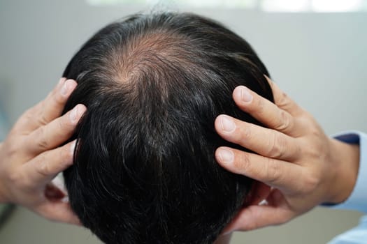 Bald head in man, hair loss treatment health problem.