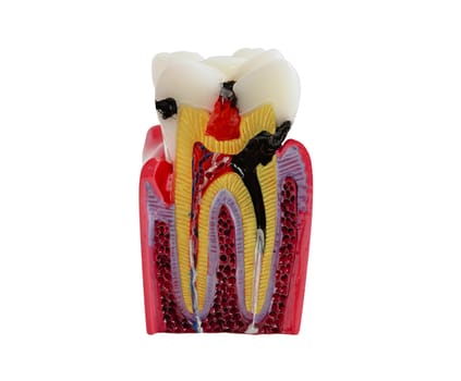 Dental implant, artificial tooth roots into jaw isolated on whtie backgroud with clipping path.