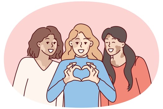 Three women with vitiligo syndrome are smiling demonstrating heart gesture as sign of self-love. Girl friends congratulate on vitiligo day calling for tolerance to people with depifmentation of skin
