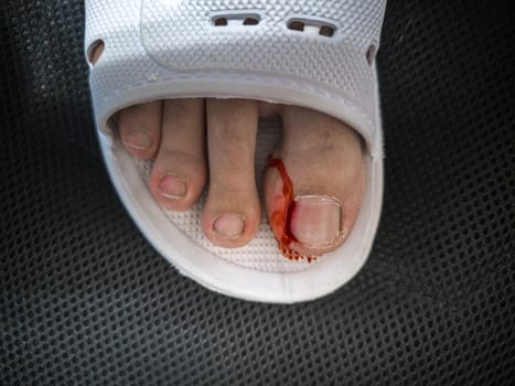 Close-up of a foot in a white plastic slipper with a bleeding toe caused by a torn hangnail. Medical theme highlighting injury, hygiene, and wound care.