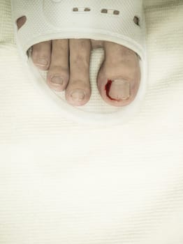 Close-up of a foot in a white plastic slipper with a bleeding toe caused by a torn hangnail. Medical theme highlighting injury, hygiene, and wound care.