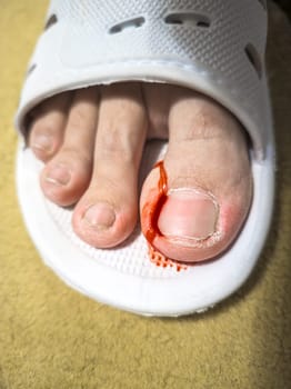 Close-up of a foot in a white plastic slipper with a bleeding toe caused by a torn hangnail. Medical theme highlighting injury, hygiene, and wound care.